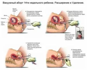 Аборт после 15 недель