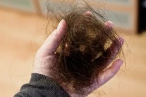 Может ли повышенный пролактин влиять на выпадение волос?