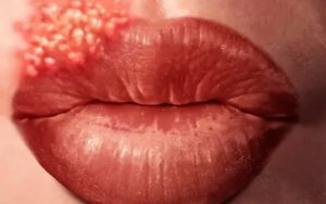 Герпес на губе после орально-генитального контакта
