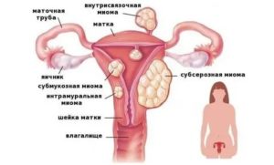 Колющая боль в области матки,  что это?