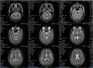Помогите расшифровать МРТ головного мозга