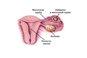 Может ли наступить внематочная беременность от Постинора?