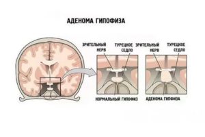 Можно ли забеременеть с аденомой гипофиза?