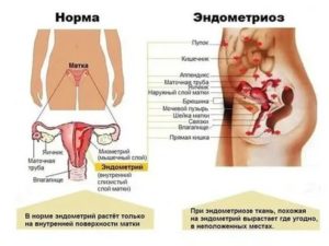 Режет во время месячных сильно низ живота