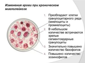 В крови обнаружились миелоциты и метамиелоциты
