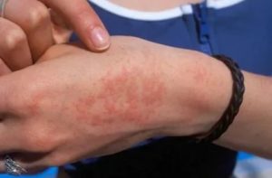 Может ли быть аллергия на Эутирокс?