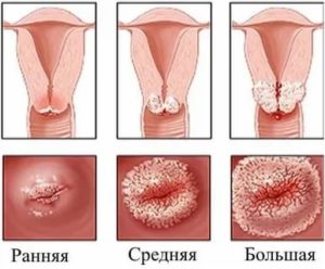 Можно ли нерожавшим прижигать эрозию?