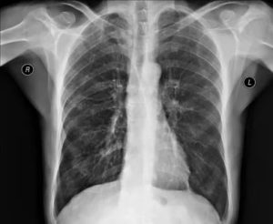 Будет ли видно эмфизему или фиброз легких на рентгене и КТ?