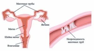 Сколько шансов на беременность с одним яичником и трубой?