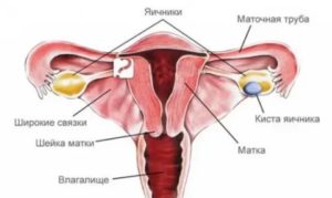 Магнитотерапия при кистах яичников и матки