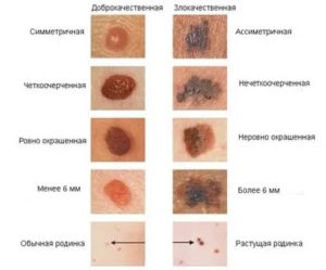 Какие признаки перерождения родинки в злокачественную?