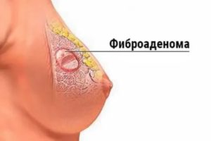 Что-то образовалось на соске, мешает