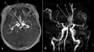 Почему МРТ не показало аневризму?