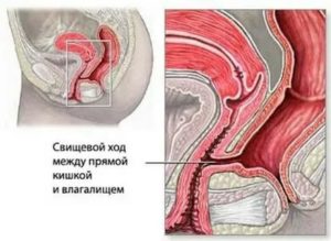 Уплотнение между влагалищем и анусом