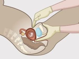 Каковы шансы забеременеть, если пальцем ввести сперму во влагалище?