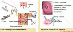 Очень обильные месячные после биопсии шейки матки