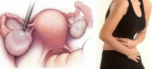 Как отличить кисту яичника от беременности на ранних стадиях по симптомам?