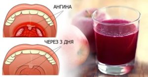 Кислота в горле после еды, что мне сейчас делать?