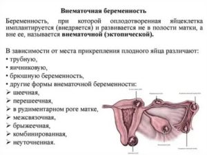 Может ли наступить внематочная беременность от Постинора?