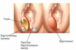 Появилась шишка с перепелиное яйцо на входе во влагалище