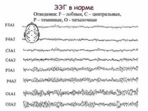 Помогите понять результат ЭЭГ