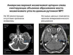 Что значит интракраниальное объемное образование?