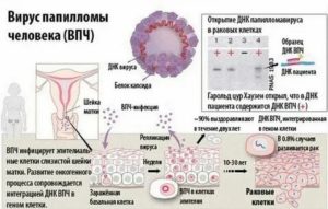 Обнаружили ВПЧ и герпес