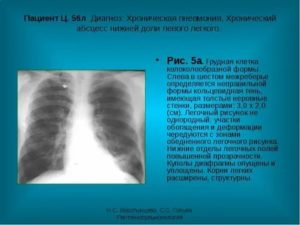 Что значит усилен рисунок в нижней доле слева?