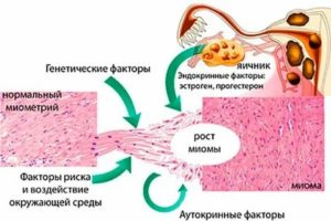 Миома матки и низкий гемоглобин