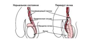 Левое яичко поднимается  вверх