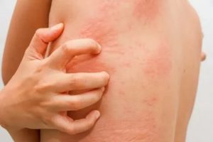 Из-за чего может быть аллергия?