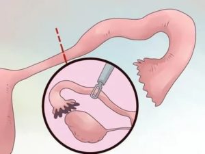 Кровотечение после удаления маточной трубы