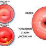 Можно ли применять Солкосерил при беременности?