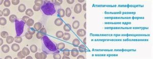 Атипичные лимфоциты, частые простуды, аллергия