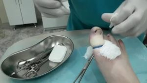 Обработка раны после удаления ногтя