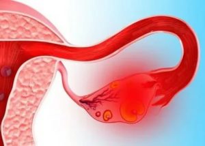 Скудные месячные после апоплексии яичника