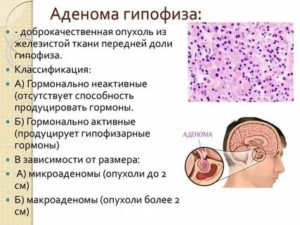 Смертельна ли аденома гипофиза?