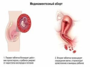 После медикаментозного аборта болит матка и грудь