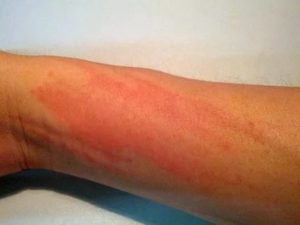 Аллергия на инъекции В12