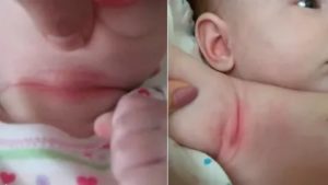 Покраснение половых губ у ребенка