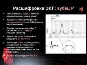 Расшифровка ЭКГ