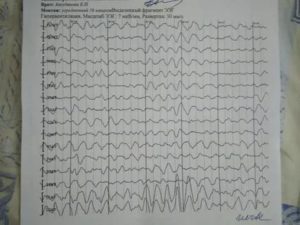 Помогите, пожалуйста, расшифровать ЭЭГ