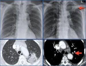Будет ли видно эмфизему или фиброз легких на рентгене и КТ?