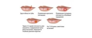 Может ли быть задержка из-за герпеса на губе?