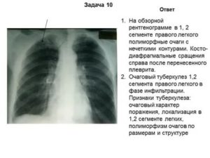 Что такое петрификаты на флюорографии?