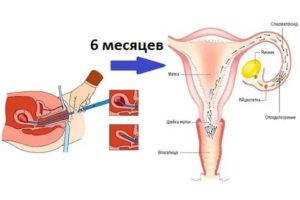 Можно ли попробовать беременность через 2-3 месяца после чистки?