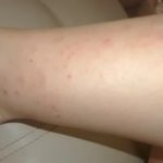 Аллергия на инъекции В12