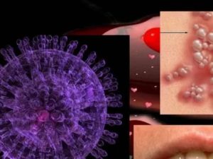 Выявлен вирус герпеса и хламидиоз
