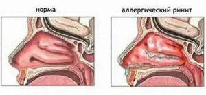 Уже месяц чувствую горечь в носу и горле, это аллергия?