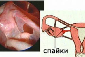 Могут ли до сих пор болеть спайки?